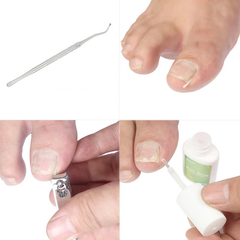 10шт силиконовых подушечек для ногтей на вросших пальцах ног Невидимые наклейки для коррекции ногтей Paronychia Recover Инструменты для педикюра По уходу за ногами - 0