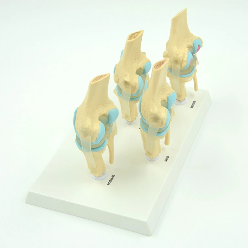 Модель скелета коленного сустава человека в натуральную величину Медицинское сравнение заболеваний коленного сустава Модель 4 для учебных пособий - 2