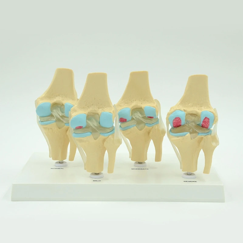 Модель скелета коленного сустава человека в натуральную величину Медицинское сравнение заболеваний коленного сустава Модель 4 для учебных пособий - 3