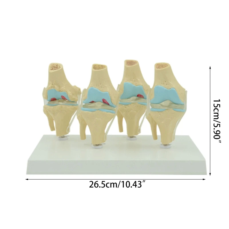 Модель скелета коленного сустава человека в натуральную величину Медицинское сравнение заболеваний коленного сустава Модель 4 для учебных пособий - 5