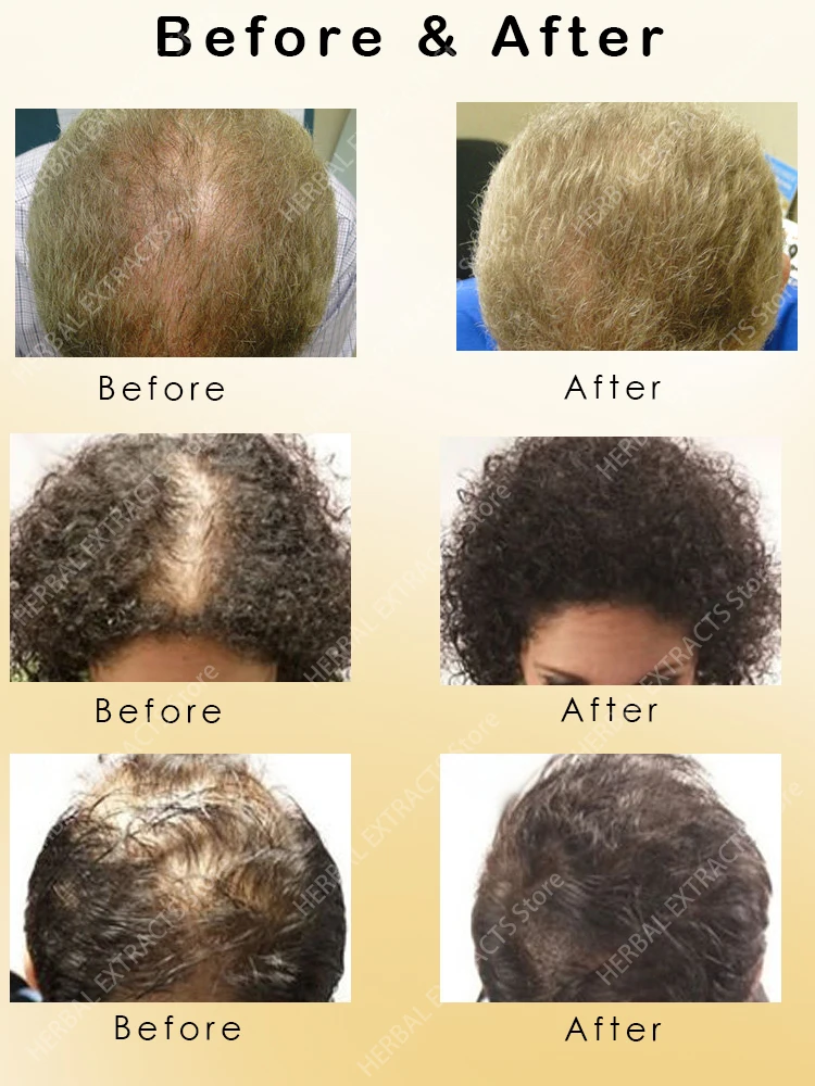 Сыворотка для здоровья густых волос для мужчин и женщин - 5